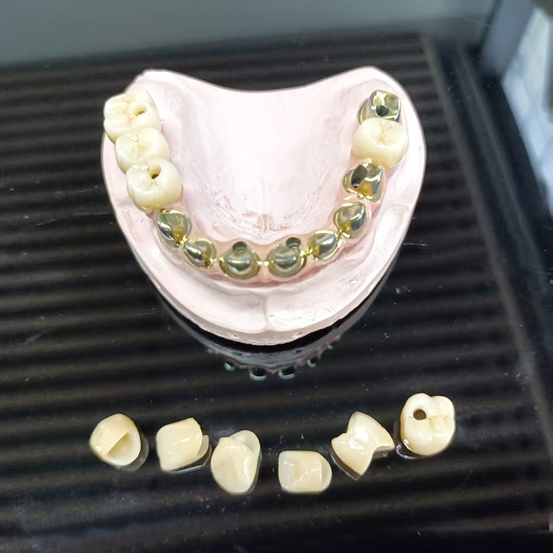 Täiskaareline metallkeraamiline sild (PFM täiskaare protees)